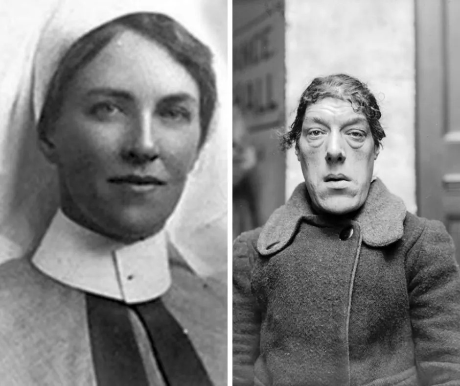 Mary Ann Bevan prima e dopo l'acromegalia